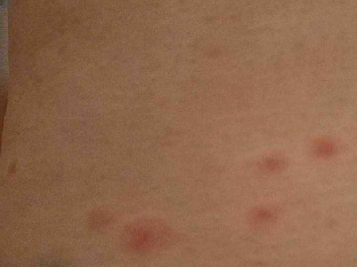 q how do you rid a very large yard of chiggers redbugs and sand fleas