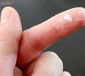 how to remove super glue from skin