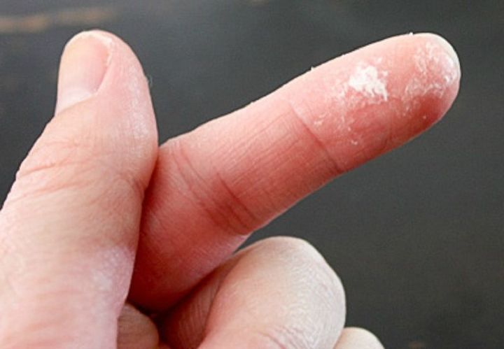 how to remove super glue from skin