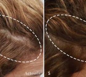 Ditch the messy serums: The high-tech secret to fuller hair